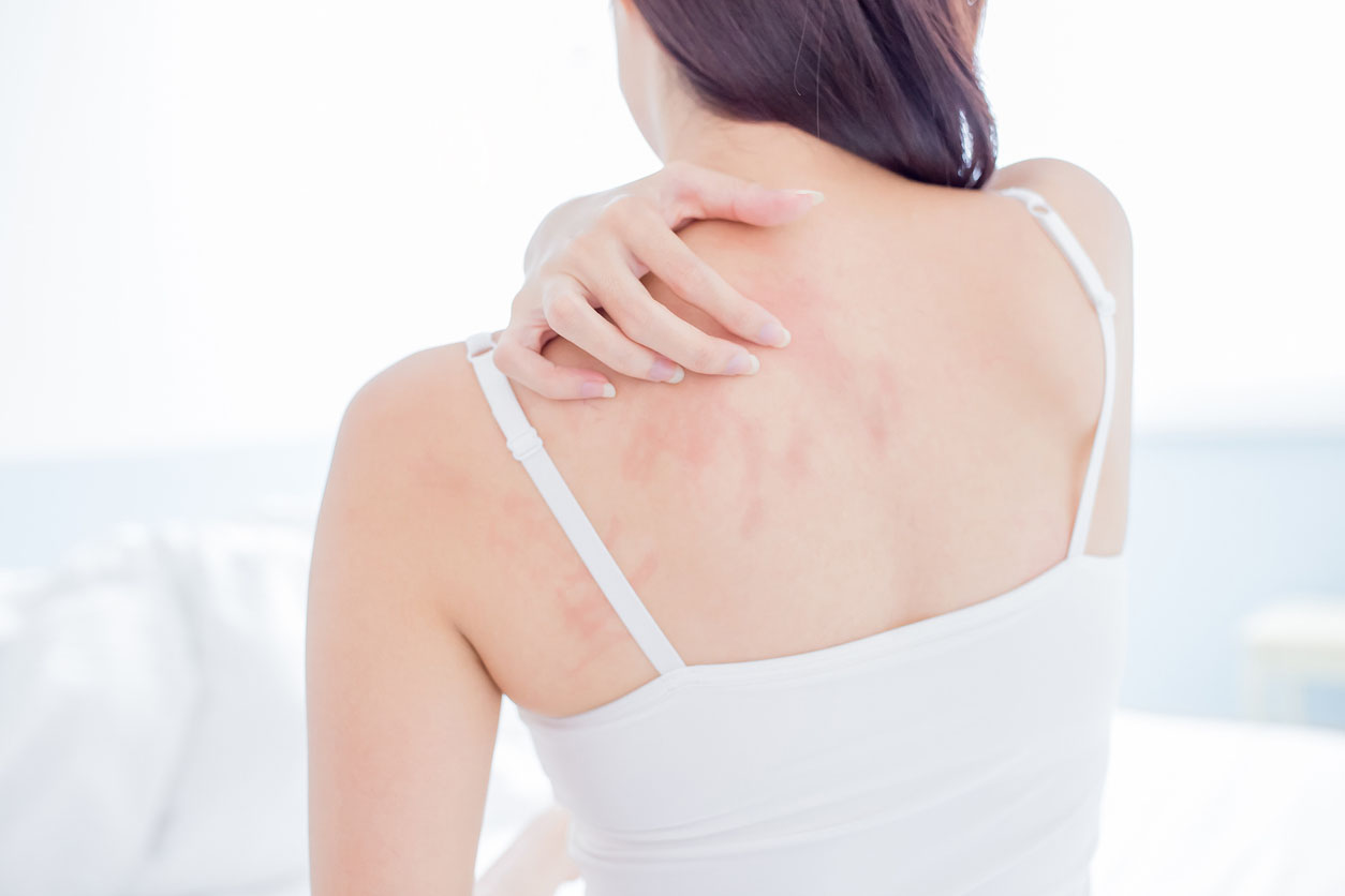 Rücken einer Frau mit trockenen Stellen und Hautrötungen